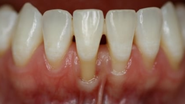 牙缝里那块肉悄悄没了，为啥再也长不回来？可能和你每天做的事有关