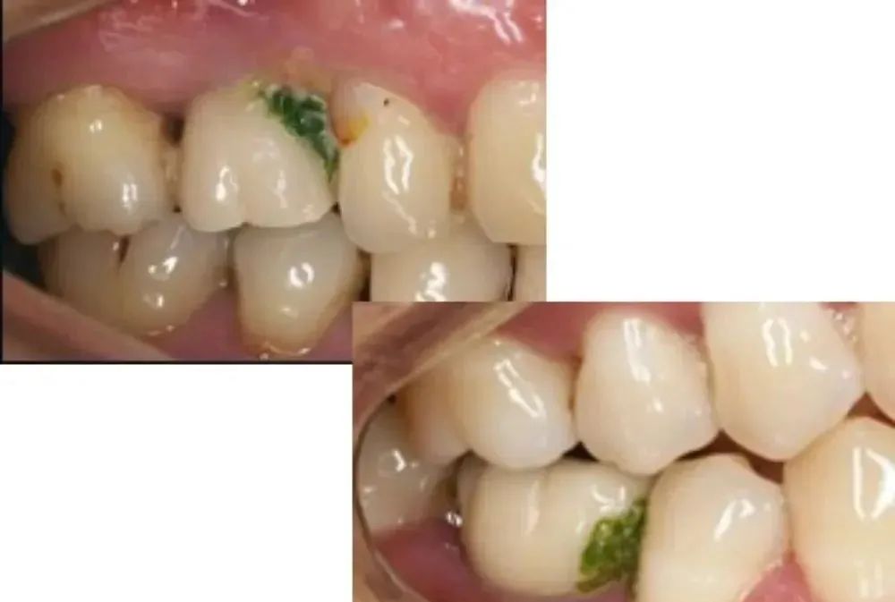 牙缝里那块肉悄悄没了，为啥再也长不回来？可能和你每天做的事有关