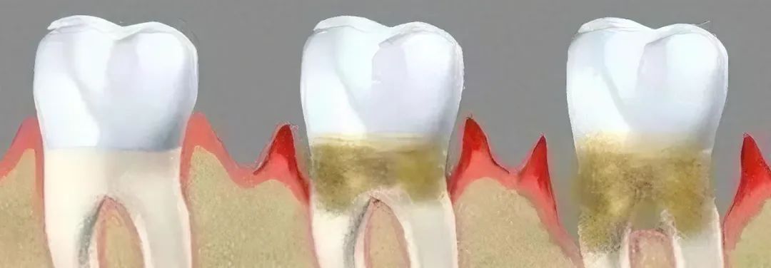 牙缝里那块肉悄悄没了，为啥再也长不回来？可能和你每天做的事有关