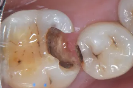 牙缝里那块肉悄悄没了，为啥再也长不回来？可能和你每天做的事有关