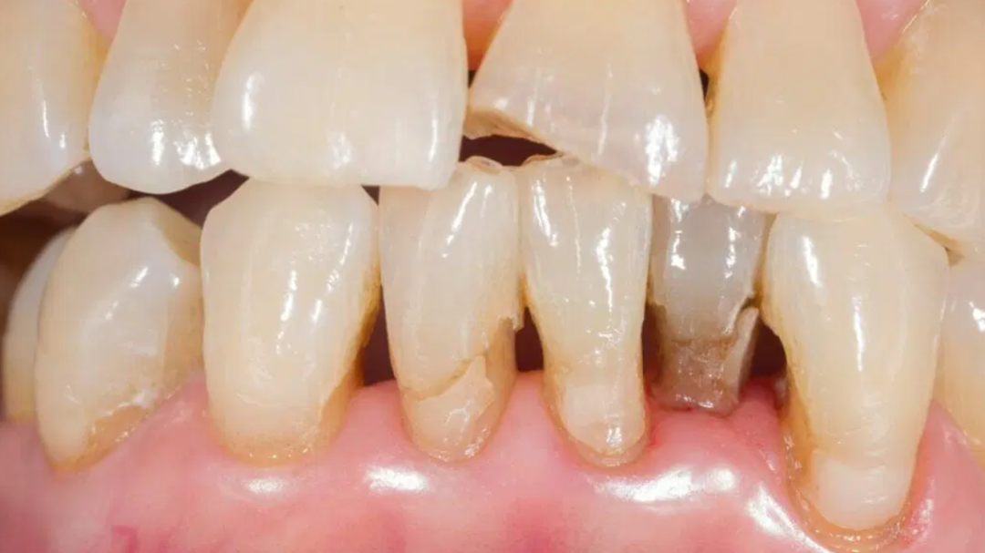 牙缝里那块肉悄悄没了，为啥再也长不回来？可能和你每天做的事有关